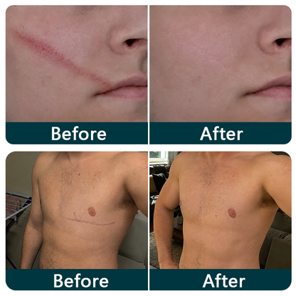 🥕Trilumia® Silicone Scar Therapy Roll — Custom-Fit Care for Long, Raised Surgical Scars