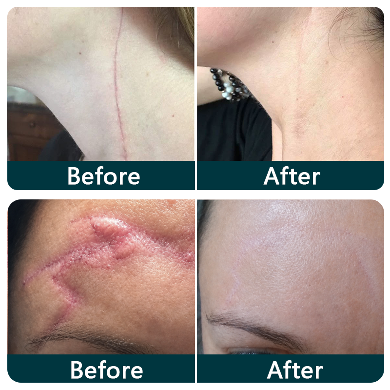 🥕Trilumia® Silicone Scar Therapy Roll — Custom-Fit Care for Long, Raised Surgical Scars
