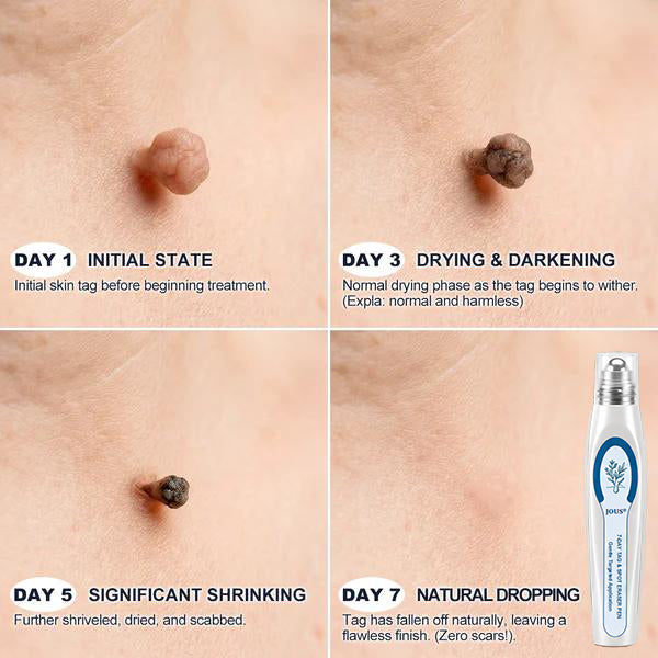 Official Store⚓𝙹𝘰ᴜs 7-𝐷𝑎𝑦 𝗧𝐚𝐠 & 𝗦𝗽𝐨𝐭 𝐄𝐫𝒂𝒔𝒆𝒓(Zero Pain, Zero 𝐒𝐜𝐚𝒓𝒔 Rollerball)