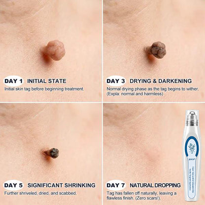 Official Store⚓𝙹𝘰ᴜs 7-𝐷𝑎𝑦 𝗧𝐚𝐠 & 𝗦𝗽𝐨𝐭 𝐄𝐫𝒂𝒔𝒆𝒓(Zero Pain, Zero 𝐒𝐜𝐚𝒓𝒔 Rollerball)