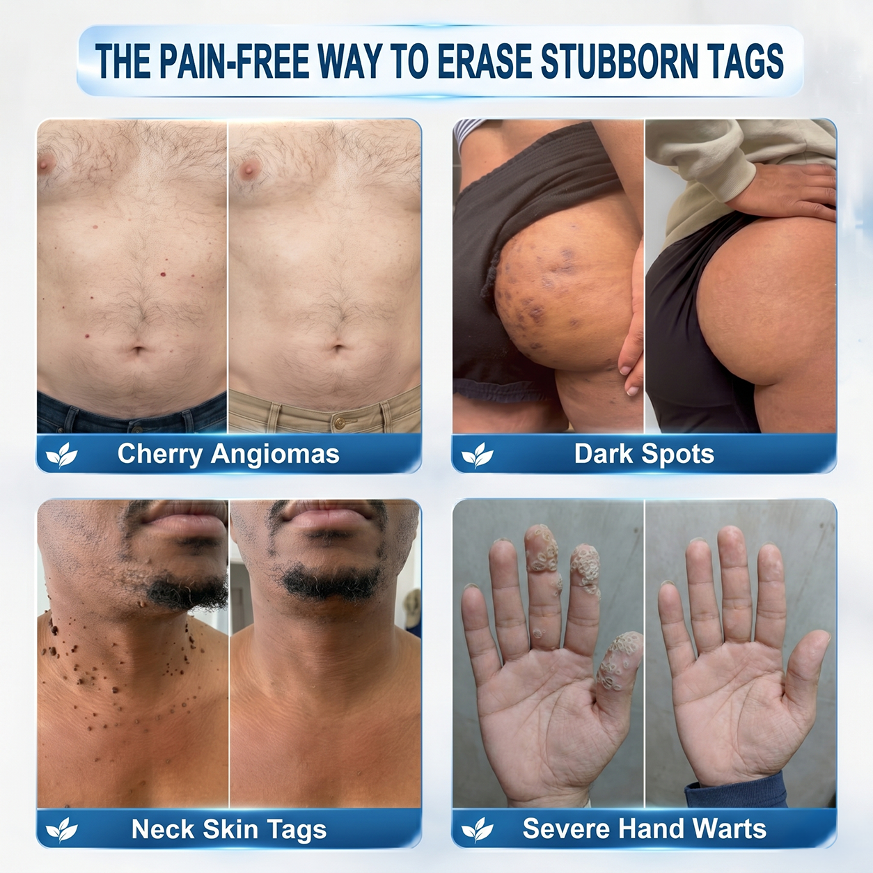 Official Store⚓𝙹𝘰ᴜs 7-𝐷𝑎𝑦 𝗧𝐚𝐠 & 𝗦𝗽𝐨𝐭 𝐄𝐫𝒂𝒔𝒆𝒓(Zero Pain, Zero 𝐒𝐜𝐚𝒓𝒔 Rollerball)