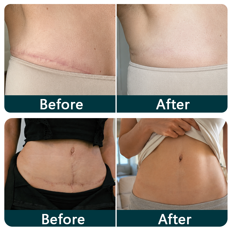 🥕Trilumia® Silicone Scar Therapy Roll — Custom-Fit Care for Long, Raised Surgical Scars
